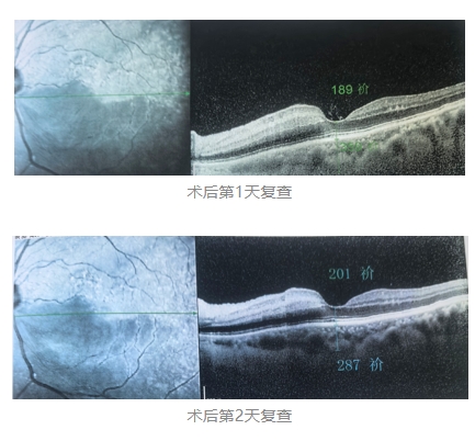 視網(wǎng)膜中央動脈阻塞